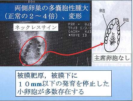 文書名 _PCOS 201407 王愛延